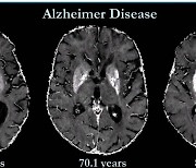 알츠하이머 예방약, 일본서도 곧 임상시험..이번엔 성공 거둘까