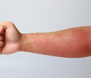 겨울철 심해지는 '알레르기성 혈관염' 조기 치료의 중요성
