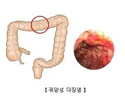 염증성 장질환 재발 예측 장치 개발