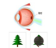 "미세먼지 노출, 황반변성 위험↑"