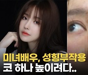 [영상] "코 하나 높이려다"..中미녀배우, 성형부작용 공개