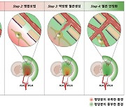 뚫지 못하는 뇌혈관 막힘, 새로운 혈관재생으로 치료한다