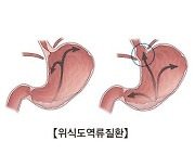 "위식도역류, 식도암·후두암과 연관"