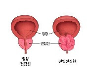 "전립선비대 치료제, 심부전 위험↑"