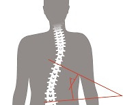 청소년 40%가 '척추측만증' 노출..각도 20% 이상되면 보조기 착용해야