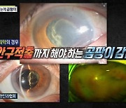 '실화탐사대' 안구 곰팡이균, 주사제서 시작된 감염 "최악의 경우 안구 적출"