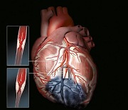 재발 위험 높은 심근경색, 관리 핵심은 'LDL콜레스테롤'