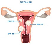 35세 이상 女 절반서 발견되는 '자궁근종' 어떻게 예방하나?