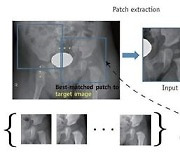 수리연구소, 소아 고관절 이형성증 조기 진단 기술개발
