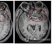 Brain Tumors Virus Treatment