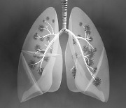 폐가 딱딱해지는 치명적인 폐질환 '폐섬유증'..조기진단 중요