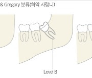 있어도 걱정, 빼는 것도 걱정..사랑만큼 어려운 '사랑니'