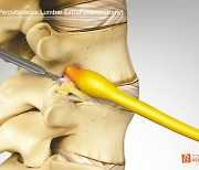 [라이프 트렌드&] 수술적 기법 접목해 다양한 척추질환 치료에 효과적인  '추간공확장술'
