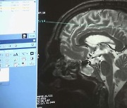 미 FDA, 18년 만에 알츠하이머 치료제 승인..치매 치료 '청신호'