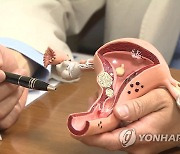 "로봇수술로 28cm 자궁근종 제거 성공..학계 보고 중 최대"