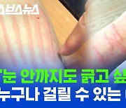 [스브스뉴스] 스치기만 해도 붓는다. 여름에 더 고통스러운 '피부묘기증'