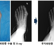 엄지발가락 휘고 아픈 무지외반증, 절개없이 발 교정·통증 치료한다