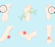 다른 증상 없이 '발냄새'만.. 무좀일까?