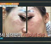 지원이 "피부 트러블 심해, 대인기피증 생길 정도" 사진 공개(건강청문회)
