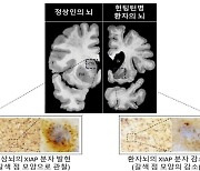 퇴행성 뇌질환 '헌팅턴병' 유발 신경세포 손상 기전 발견