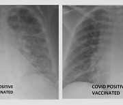 X레이 사진으로 본 코로나 백신의 효과..'흑백 차이' 극명