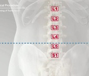 [라이프 트렌드&] 난도 높은 L5~S1 추간공확장술의 성패는 집도의의 경륜과 노하우가 좌우