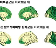 한해 49만명..가장 무서운 고령화 적 알츠하이머 진행 늦추는 물질 확인됐다