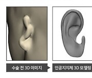 티앤알바이오팹 "소이증 환자에 귀 재건용 인공지지체 이식 성공"