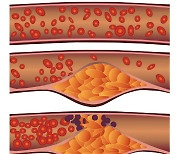 혈액 속에 떠다니는 '기름' 없애야 약될까?