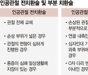 손상부위만 교체.. 내 관절 최대한 살려주는 '인공관절 부분치환술' [주목해야 할 신의료 기술]