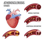 "항산화물질 시스테아민, 동맥경화 진행 차단"