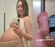 '104kg' 황신영, '세쌍둥이 임신'에 휠체어 신세→퉁퉁 부은 발.."이틀만 버텨줘"