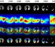 분간 어려운 폐렴과 코로나19 환자..'AI'로 정확하게 찾아낸다