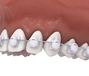 펄레이스 치아교정장치 국제특허 및 미 FDA 등록