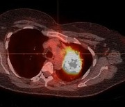 "담배 안피우고 폐암 걸린 사람 80%는 표적 항암제로 치료 가능"