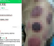 부작용 걱정에, 부항 떠서 백신을 뽑아낸다고?.. 황당 해독법 논란