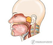 "두경부암, 4기여도 수술과 항암치료 병행하면 생존률 높아져"