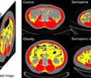 위암 잘 극복하려면 근육량 늘려야.. 근감소성 비만 위암 환자 장기생존율 낮아