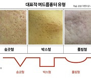 여드름 흔적들.. 흉터 치료 방법은?