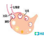 "찌릿"..생리통보다 더 아프기도 한 '배란통'의 정체는?