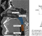 CT 활용한 폐쇄성 수면무호흡증 검사 예측 효과 밝혀
