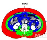 비만의 역설? 내장·피하지방 많으면 대장암 재발 위험성↓