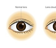 백내장, 젊다고 방심 금물..의외의 유발 요인은?