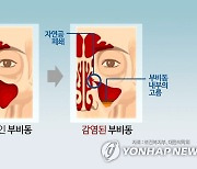 "축농증 수술 효과, 환자 DNI 보면 알 수 있다"