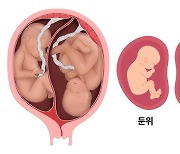 "쌍둥이도 거꾸로 태어나면 고관절 비정상적 발달 위험"