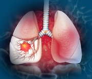 암 사망률 1위 폐암, 신약 개발 경쟁 붙는다
