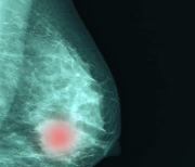 유방암 초음파 영상 AI가 학습하니..예측 정확도 90%로 향상