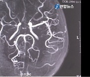 '미세혈관이 연기 모양' 모야모야병, 소아 뇌졸중 원인