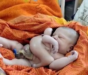 팔과 다리 4개 달린 아기 인도에서 태어났다, 가족은 "의사 고소하겠다"
