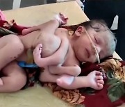 인도서 팔·다리 8개 달린 아기 태어나.."신의 화신"